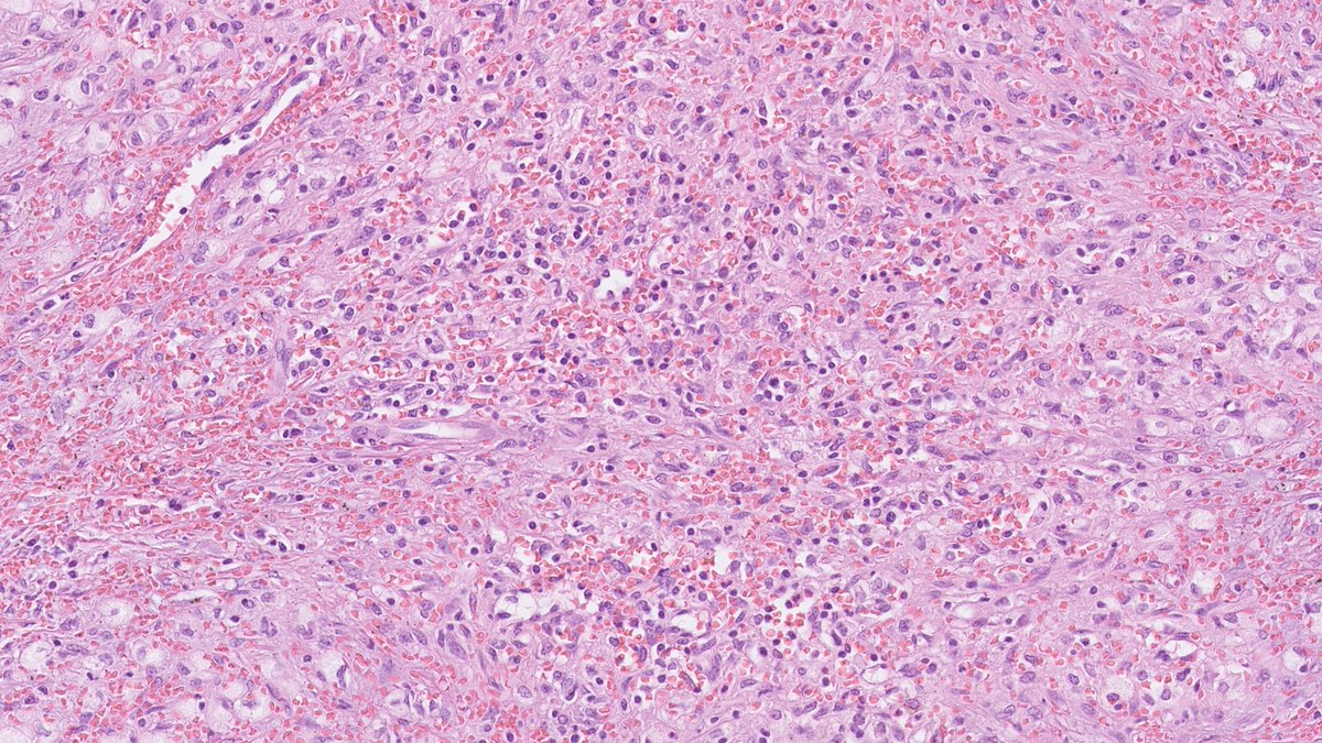 Sclerosing angiomatoid nodular transformation
▶️benign
▶️nodular appearance on low magnification
▶️composed of small venules, capillaries, and sinuses surrounded by fibrotic stroma
▶️plumped endothelial cells, no atypia
▶️numerous inflammatory cells
#hemepath #PathTwitter #PathX
