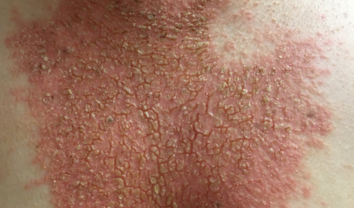 Cory Simpson, MD, PhD, FAAD (he/him) tweet media