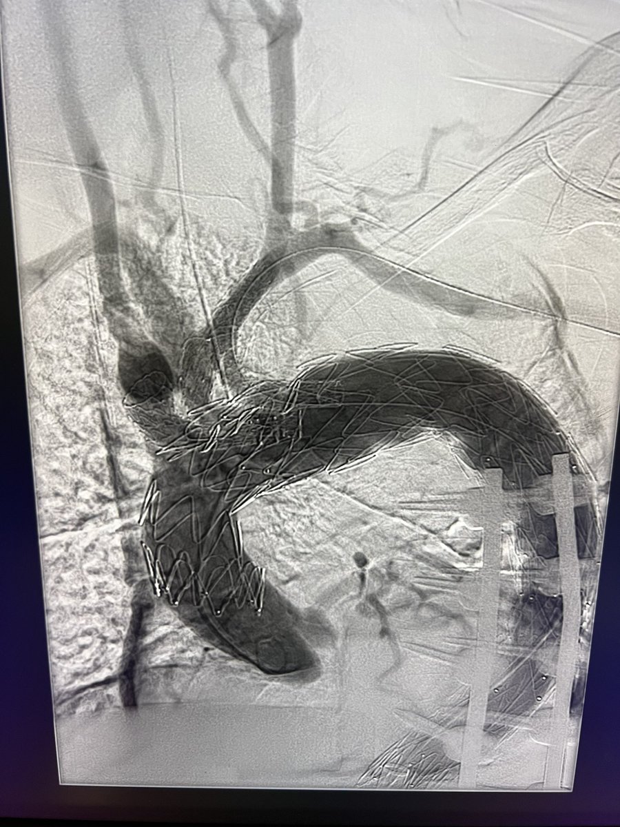 Elderly pt - CHF, CKD IV, COPD- prior FEVAR now with occult type Ia at LSA. Symptomatic 8cm arch. Not open candidate Completely transfemoral 3v Arch - Home on POD7. Alpha 40x36 with 3 retro branches-20Fr Bullet nose cone- Gore side branch for great vessels #aortaed #cook #gore
