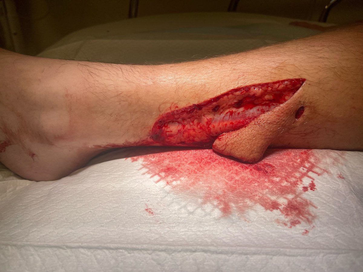 braydencupach's tweet photo. July 27th, 2023: Cut my legs and feet open in a freak accident and had to get 58 stitches, millimeters away from slicing my muscle and peripheral artery.
August 18th, 2023: Played week 1 just 9 days after getting my stitches removed.
November 3rd, 2023: Last high school game. https://t.co/SYIQQ60jqy