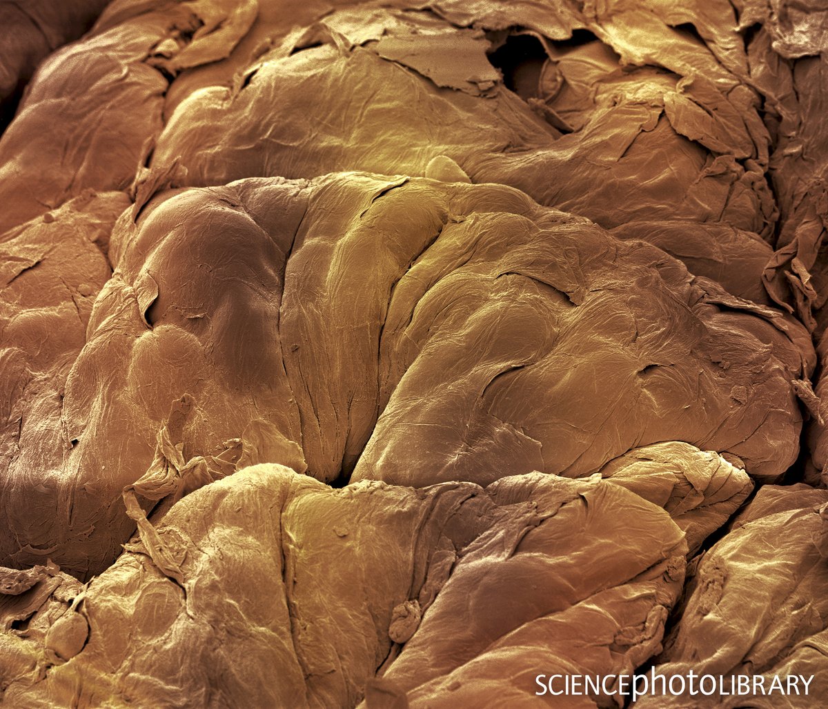 sciencephoto's tweet photo. Melanocytic naevi, also known as a skin mole.
SEM of detail from a human skin mole. They are correctly called melanocytic naevi, as they are due to a proliferation of the pigment cells, melanocytes.
C:Steve Gschmeissner/SPL
https://t.co/Rui53nPiqe
#benign #mole #naevi #naevus https://t.co/2U0rugNxQk