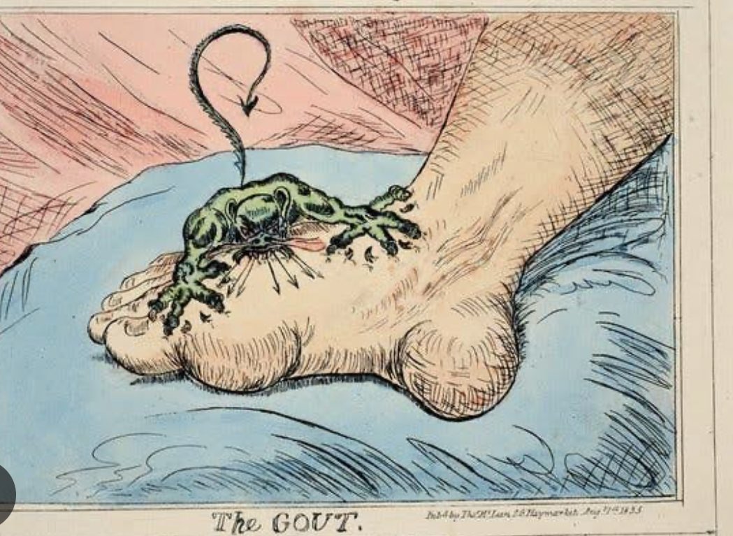 🦶🦶Gout management in CKD 
#KidneyWk 

➡️Historical picture 

🦶swollen and inflamed foot-gout is represented as an attacking demon 👿

🔖J. Gillray, 1799

@PaulPalevsky 🎙️

😟How do u manage gout in CKD👇