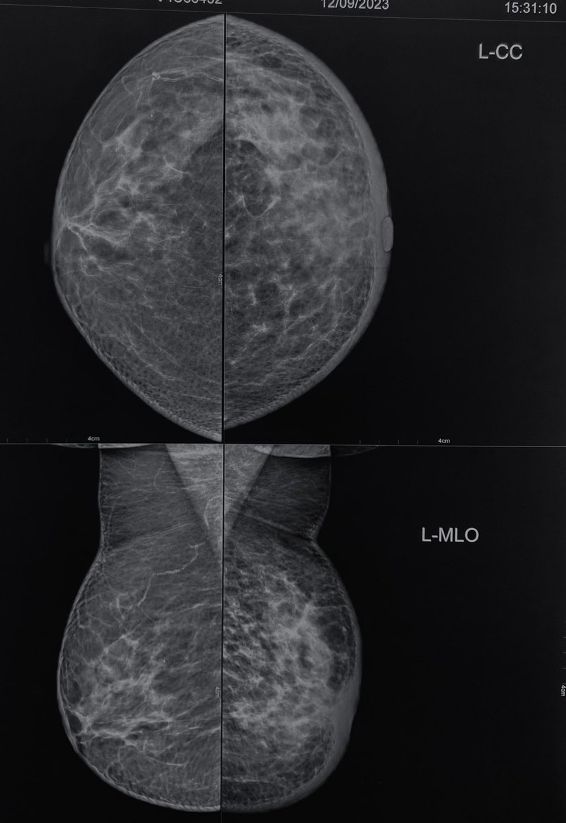 Elderly female patient came with gradual onset increase in size of left breast over months. Initial mammogram and latest mammogram done are 9 months apart. What do we see here? What do we advise when we see the first mammogram? #Breastimaging #Mammogram #Radres #Radtwitter