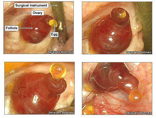 Rainmaker1973's tweet photo. Dr Jacques Donnez was the first person to (accidentally) witness human ovulation with the naked eye in 2008.

The starting point of every human life was observed during a hysterectomy at UCL in Brussels.

Because ovulation happens so infrequently (13 times per year in the average woman), happens rather quickly (maximum 15 minutes from beginning to end), and because we never know for sure when ovulation will exactly take place, it has been very difficult to clearly photograph or film this event.