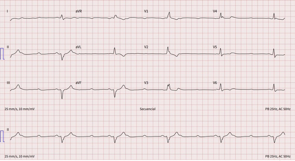 Opinions?? @ecgrhythms @ECGfan @MosqueaRubelin @drahmedmohsen85 @HaseebEPHF @primastcar @syamkumarmd @ArritmiasSAC @SchakrabartiEP @ArritmiasNegrin @BrooksWalsh @DidlakeDW @carprimur @smithECGBlog @EF_Cardiaca @ECGcases @The_Nanashi_O @AThomazAndrade @Arron_Pearce_ @jovenesSec