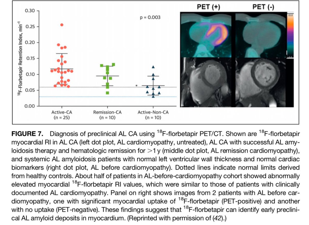 Molecular Imaging of Systemic and Cardiac Amyloidosis jnm.snmjournals.org/content/64/Sup… Amyloid PET imaging is expected to play a crucial role in early diagnosis and in monitoring of therapy @DorbalaSharmila @SNM_MI @ESC_Journals @alexsfelixecho @estelais @pabeda1 @WiefelsC @BeanlandsRob