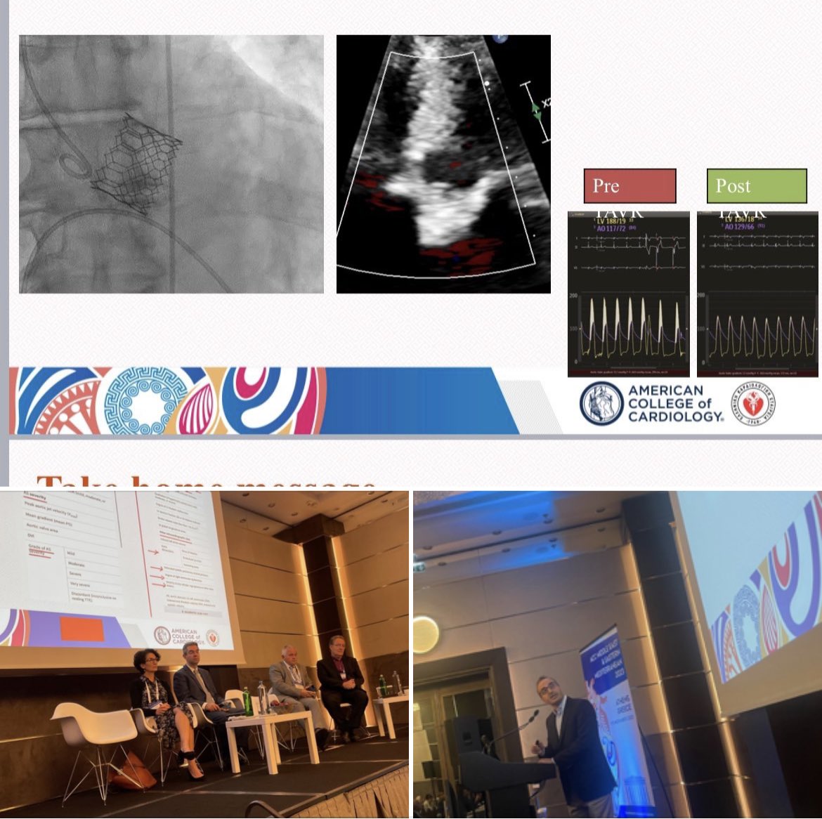 Dr_KSAV's tweet photo. Treating bicuspid aortic valve stenosis patients #ACCMidEastMed #tavi #ACC #bicuspid @ACCinTouch @HCSgr https://t.co/RKjsEk1JFt