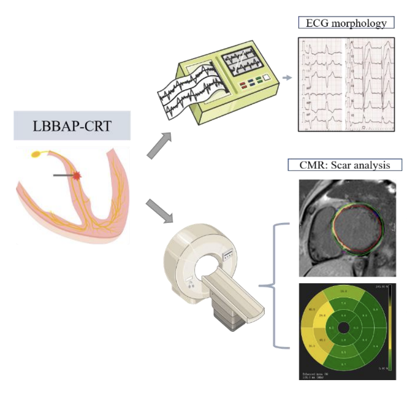 Europace Editor-in-Chief (@europaceeic) on Twitter photo 📢 #Europace #LBBAP #CRT #EPeeps
How does #CMR-derived scar burden predict the response of CRT via LBBAP?
👉bit.ly/3FJosAb
<a href="/GiulioConte9/">Giulio Conte</a> <a href="/FraSantoroMD/">Francesco Santoro, MD, PhD</a> <a href="/AndyZhangMD/">Xiaodong Zhang (Andy), MD, PhD, FHRS, FACC</a> <a href="/marcovitoloMD/">Marco Vitolo Ⓜ️</a> <a href="/LuigiDiBiaseMD/">Luigi Di Biase</a> <a href="/PrashSanders/">Prash Sanders</a> <a href="/DrJasonAndrade/">Jason Andrade</a> <a href="/Drdevignair/">Dr. Devi G Nair</a> <a href="/ALFIEEP1/">ALBERTO ALFIE</a> <a href="/KennethEllenbo1/">Kenneth Ellenbogen</a> 📢 #Europace #LBBAP #CRT #EPeeps
How does #CMR-derived scar burden predict the response of CRT via LBBAP?
👉bit.ly/3FJosAb
<a href="/GiulioConte9/">Giulio Conte</a> <a href="/FraSantoroMD/">Francesco Santoro, MD, PhD</a> <a href="/AndyZhangMD/">Xiaodong Zhang (Andy), MD, PhD, FHRS, FACC</a> <a href="/marcovitoloMD/">Marco Vitolo Ⓜ️</a> <a href="/LuigiDiBiaseMD/">Luigi Di Biase</a> <a href="/PrashSanders/">Prash Sanders</a> <a href="/DrJasonAndrade/">Jason Andrade</a> <a href="/Drdevignair/">Dr. Devi G Nair</a> <a href="/ALFIEEP1/">ALBERTO ALFIE</a> <a href="/KennethEllenbo1/">Kenneth Ellenbogen</a>