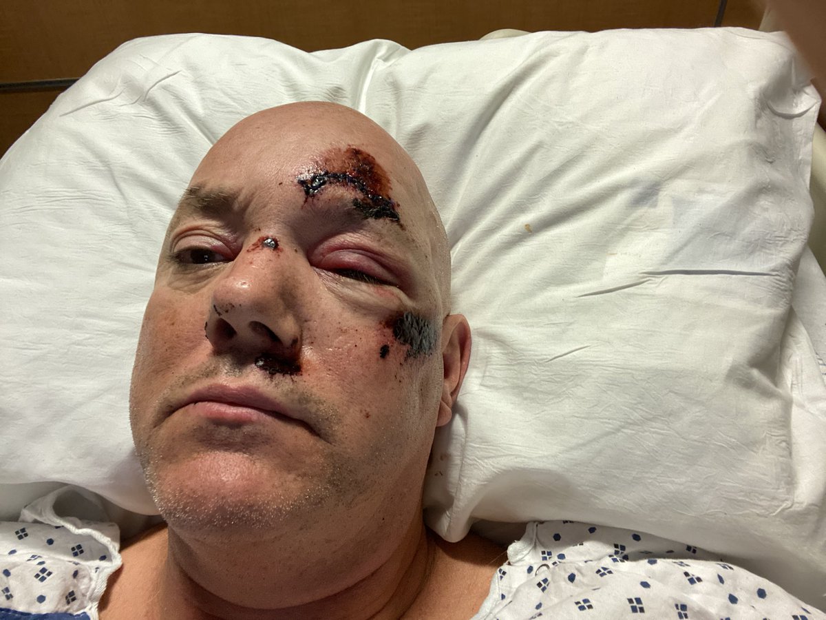 WhitcherJames's tweet image. I am recovering at INOVA Hospital in Fairfax Va. I was riding my bicycle 🚴 Tuesday night and struck by a vehicle., hit and run. Brought to shock trauma and lucky to be alive. I need help please if you can provide and know it’s going to a good place.