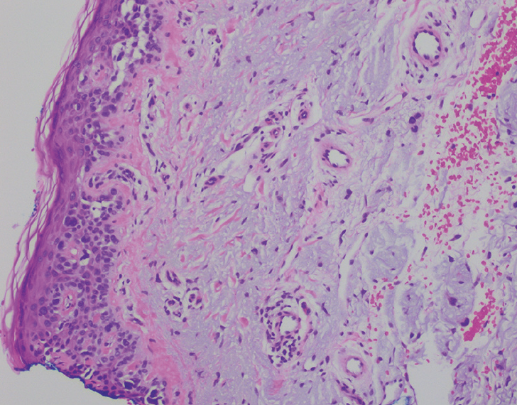 Practical_Derm's tweet photo. This case serves as a crucial reminder for #Mohs surgeons, #dermatologic surgeons, and #dermatopathologists to be vigilant when examining pathologic specimens for other important diagnoses unrelated to the primary tumor being excised. https://t.co/0ItQeNhJGT https://t.co/A8icQ2qj3L