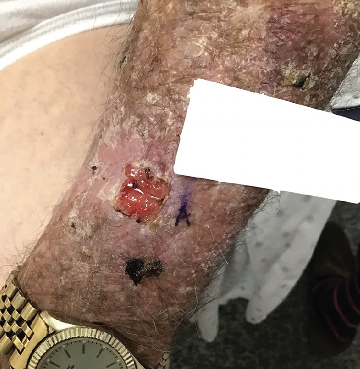 Practical_Derm's tweet photo. This case serves as a crucial reminder for #Mohs surgeons, #dermatologic surgeons, and #dermatopathologists to be vigilant when examining pathologic specimens for other important diagnoses unrelated to the primary tumor being excised. https://t.co/0ItQeNhJGT https://t.co/A8icQ2qj3L