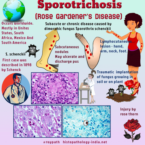 schowardjd's tweet photo. @docxusofficial Sporotrichosis, lymphocutaneous
"Rose Gardener's disease"
Sporothrix schenckii

(image credit: @DrSampyRoy, #RoyPath) https://t.co/0Q78PAKYY3