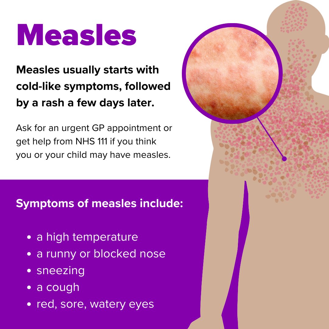 Measles is a highly contagious virus that can have serious health consequences, but we can protect ourselves and our communities through vaccination. 

For more information on measles, go to nhs.uk/conditions/mea…

 #Vaccines #Measles #MMRVaccine #MMR