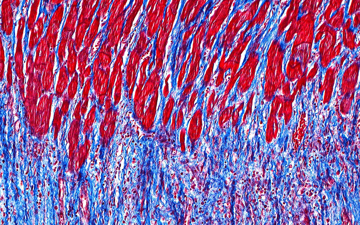 'Trichrome Flames'  #PathArt 

Trichrome stain of myocardial fibrosis (red = cardiomyocytes, blue = fibrosis) #CardiacPath #CVpath #autopsy