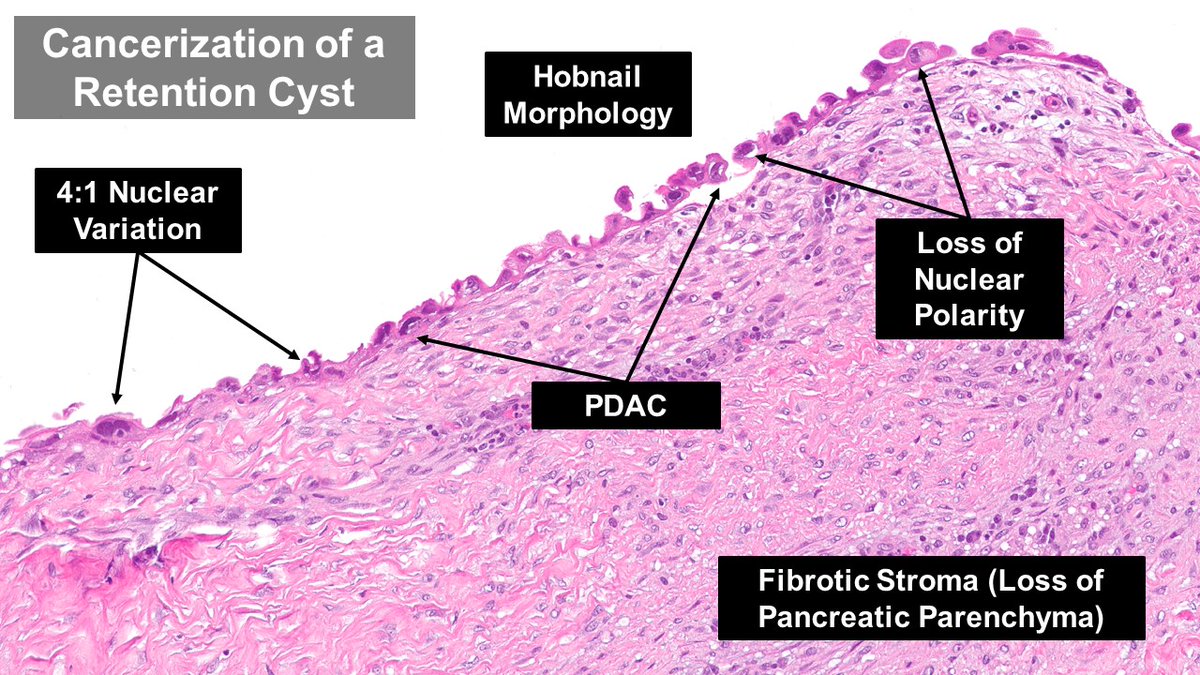 Pancreatic Ductal Adenocarcinoma (#PancreaticCancer) causing obstructive chronic pancreatitis & retention cysts. #Pancreatitis is a common symptom for patients with #PDAC. #RetentionCysts colonized by PDAC. #GIPath #Pathology #PancreaticPathology #PancreaticCancerAwarenessMonth
