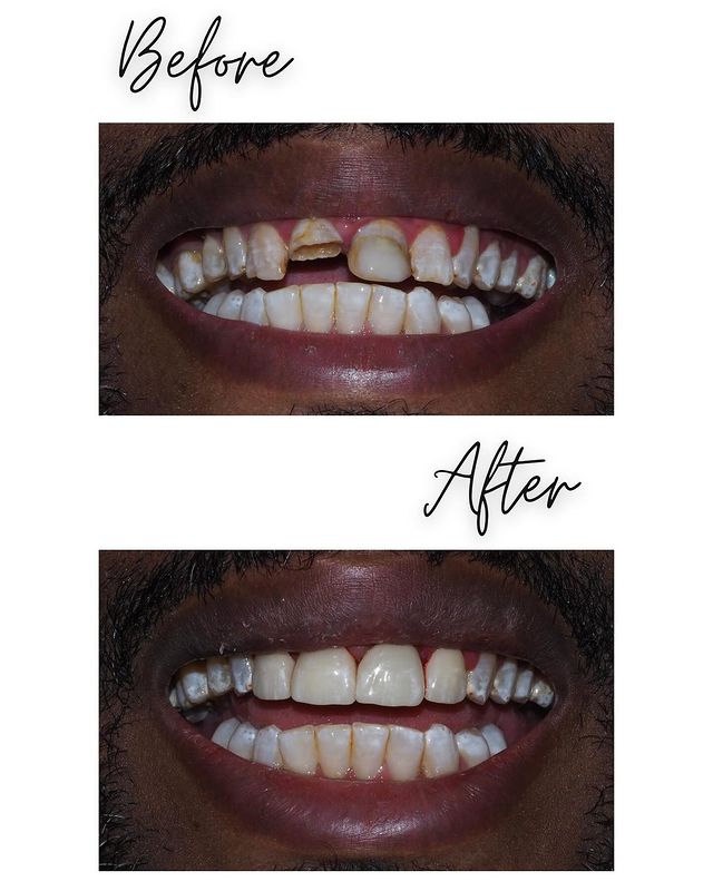 promenadecenter's tweet photo. "🌟 Dr. Alina completes outstanding crown work! Our patient with previous larger fillings experienced some wear over time. Dr. Alina's strategy involved removing the remaining fillings and perfectly crowning 7-10. 🦷✨https://t.co/ku68KUFuhe https://t.co/R09RjDG5pN