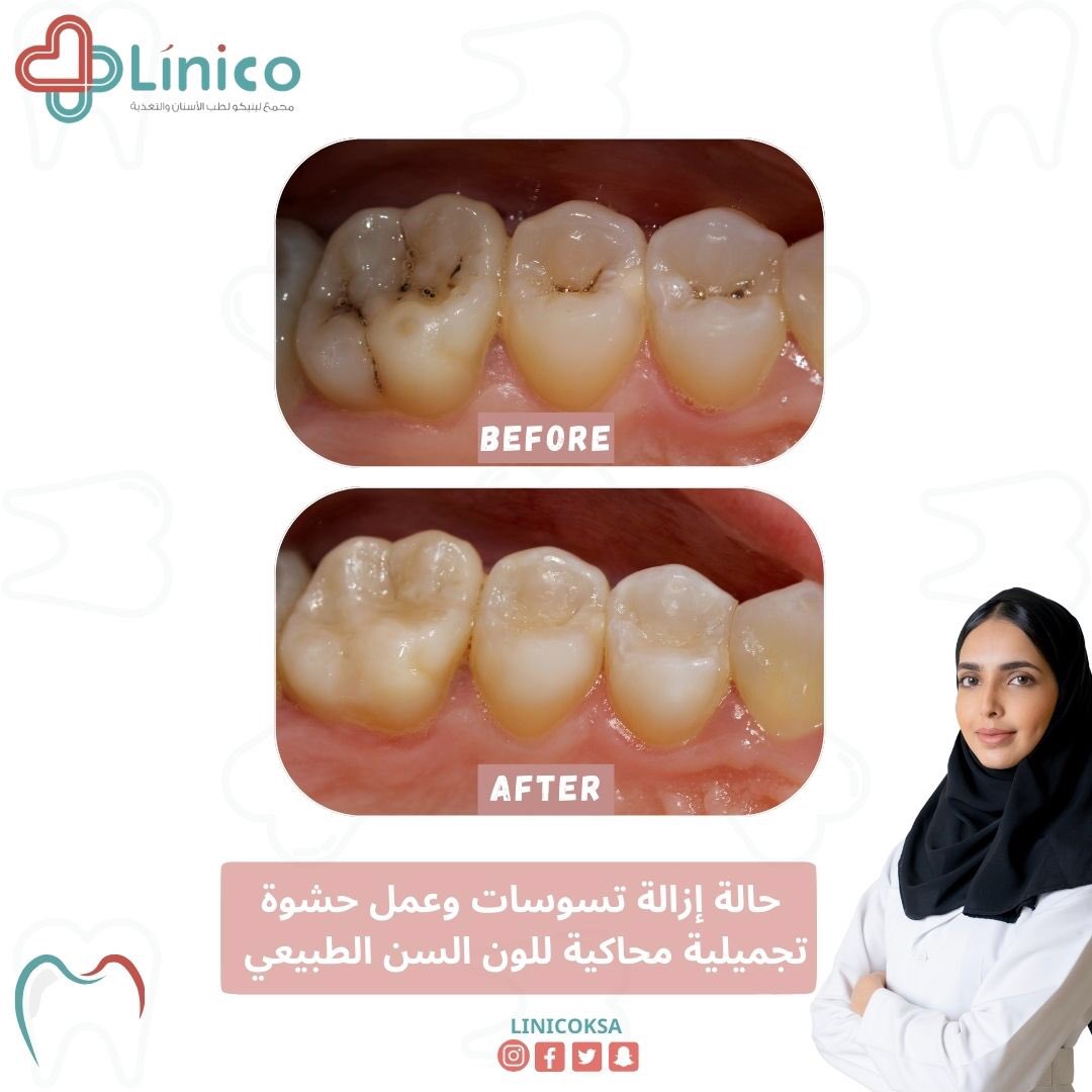 حالات قبـل وبعد 
مع الدكتورة / أُلفت أحمد 🦷 ✨ 

للحجز والاستفسار : 📞 
0590487084