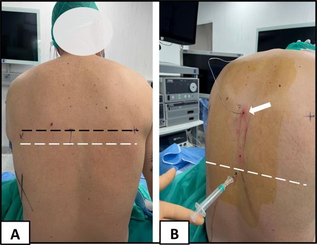 European Urology Open Science (@eururolopen) on Twitter photo Case Report: A New Concept in Minimally Invasive Surgical Treatment in Renal Cancer: The Use of Neuroaxial Anesthesia During Laparoscopic Partial Nephrectomy
buff.ly/49lIrlI
<a href="/AlbertoPiana2/">Alberto Piana</a> <a href="/JacopoLauria/">Jacopo Lauria</a> <a href="/CappaManlio/">manlio cappa</a> <a href="/EnricoCheccucci/">Enrico Checcucci</a> <a href="/danieleamparore/">Daniele Amparore</a> <a href="/PorpigliaF/">Porpiglia Francesco</a> Case Report: A New Concept in Minimally Invasive Surgical Treatment in Renal Cancer: The Use of Neuroaxial Anesthesia During Laparoscopic Partial Nephrectomy
buff.ly/49lIrlI
<a href="/AlbertoPiana2/">Alberto Piana</a> <a href="/JacopoLauria/">Jacopo Lauria</a> <a href="/CappaManlio/">manlio cappa</a> <a href="/EnricoCheccucci/">Enrico Checcucci</a> <a href="/danieleamparore/">Daniele Amparore</a> <a href="/PorpigliaF/">Porpiglia Francesco</a>