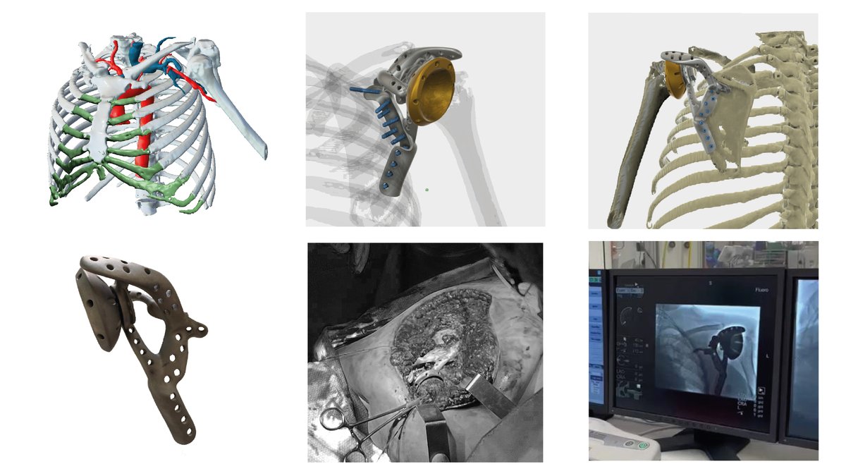 FabLab 3D Hospital Marañón (@3d_maranon) on Twitter photo Custom-made implant (CMD IIb) in a case of chondrosarcoma of the left scapula designed and manufactured in medical grade titanium. It allowed patient's shoulder mobility.
<a href="/rupermac/">Rubén Pérez-Mañanes, MD PhD</a> <a href="/LydiaMediavilla/">LydMed</a> <a href="/calvoharo_ja/">José Antonio Calvo</a> #UPAM3D #HospitalGregorioMarañon #impresion3D Custom-made implant (CMD IIb) in a case of chondrosarcoma of the left scapula designed and manufactured in medical grade titanium. It allowed patient's shoulder mobility.
<a href="/rupermac/">Rubén Pérez-Mañanes, MD PhD</a> <a href="/LydiaMediavilla/">LydMed</a> <a href="/calvoharo_ja/">José Antonio Calvo</a> #UPAM3D #HospitalGregorioMarañon #impresion3D