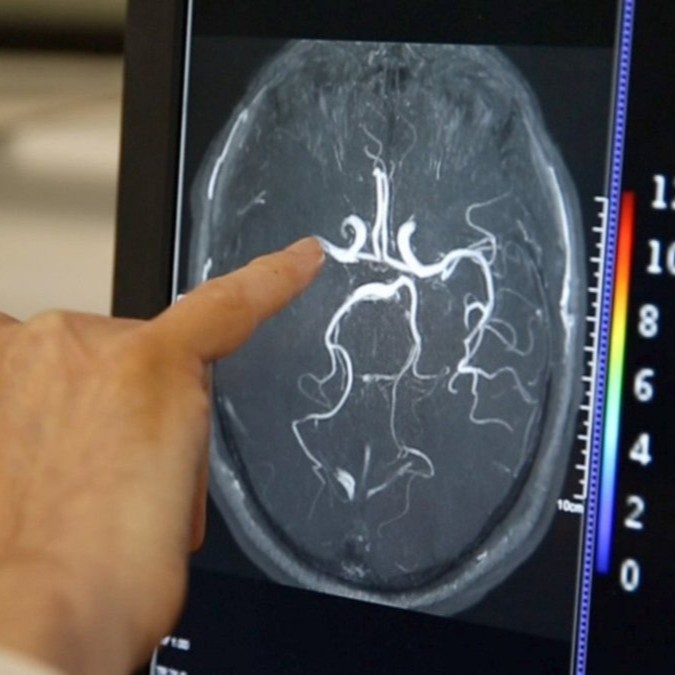 Your brain is amazing! 🧠♻️

A stroke presents a blockage in the brain that can affect your ability to walk, talk, read or write. But through a process called neuroplasticity, your brain can rewire itself, bypass the blockage, and recovery can begin! More: bit.ly/3tJcYUK