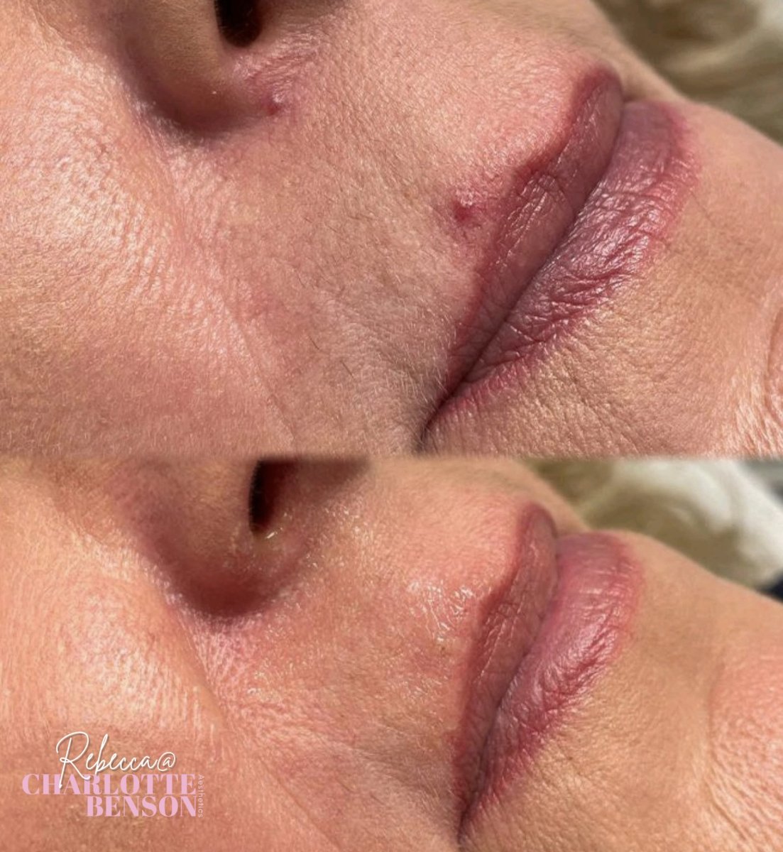 cb_aesthetics_'s tweet photo. 𝐒𝐩𝐢𝐝𝐞𝐫 𝐍𝐚𝐞𝐯𝐮𝐬, also known as spider veins or spider telangiectasias, can be treated with electrolysis. Electrolysis is a method that uses an electric current to destroy the blood vessels causing the spider naevus. 

👩🏻‍⚕️ 𝗥𝗲𝗯𝗲𝗰𝗰𝗮 𝘄𝗶𝗹𝗹 𝗯𝗲 𝗷𝗼𝗶𝗻𝗶𝗻𝗴 https://t.co/YFBS47ZzF9