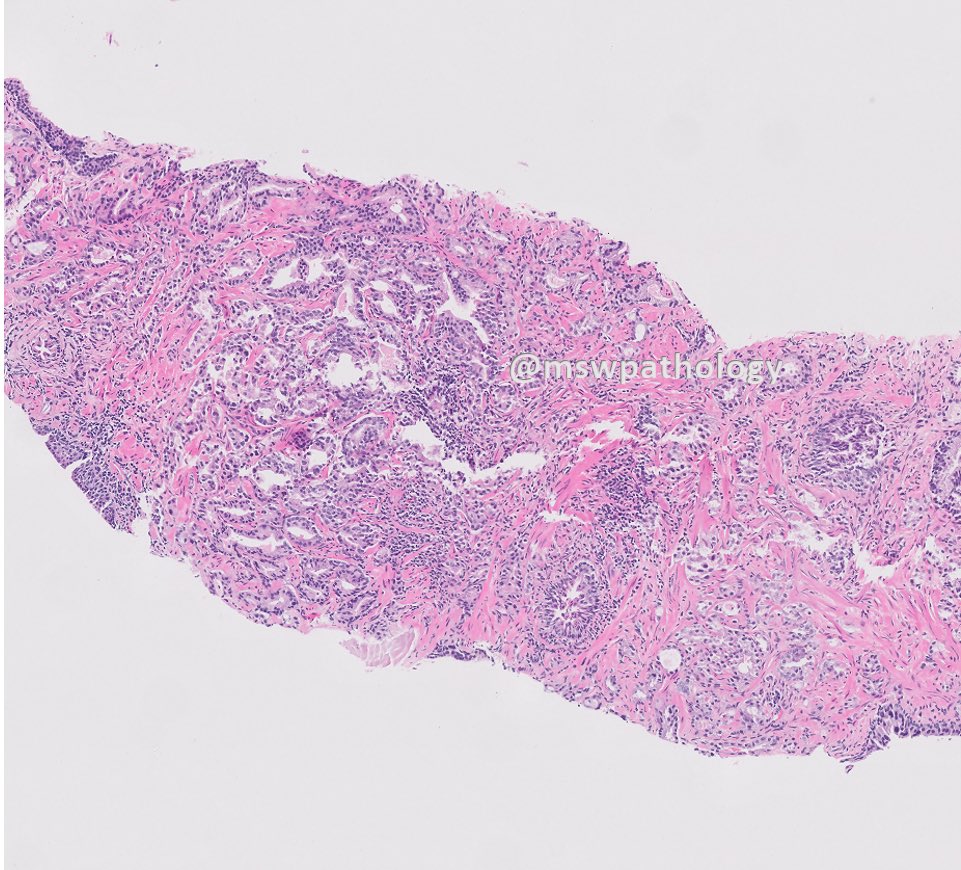 🔹Case of the week #10🔹
▪️Prostate biopsy showing adenocarcinoma… Gleason score?

Stay tuned for answer this Friday! Enjoy the rest of the week 🎈