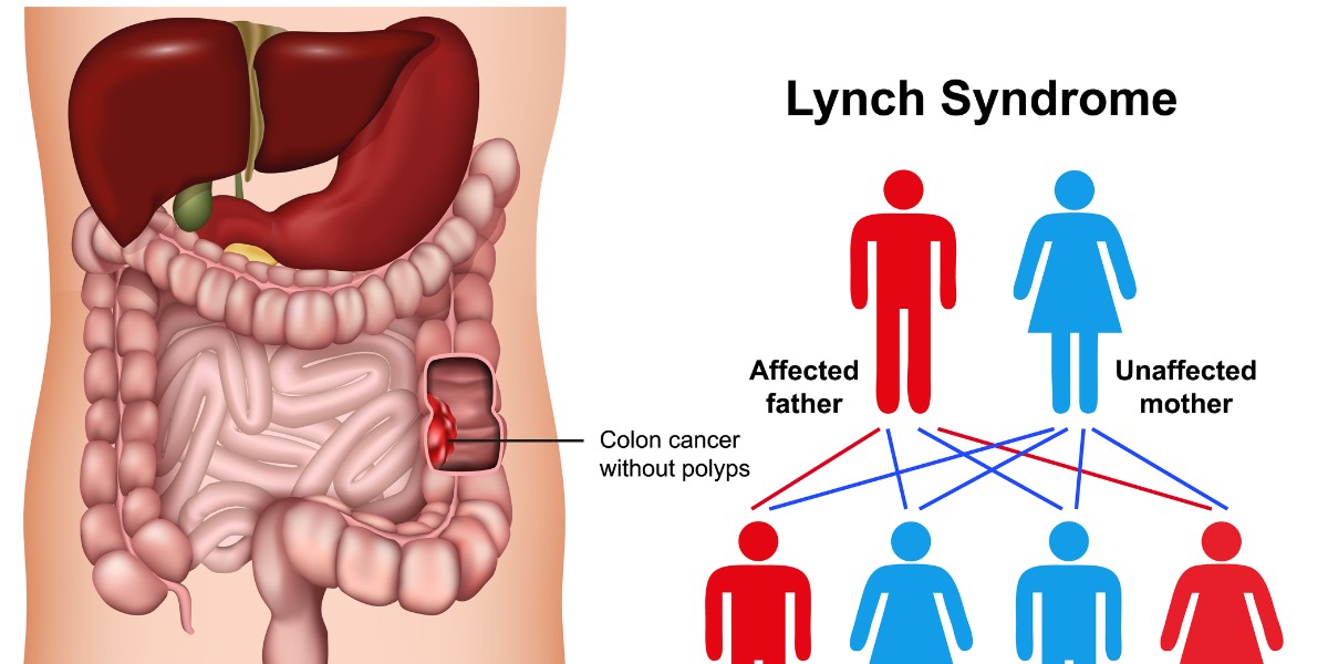 Gastro_Advisor's tweet photo. Patients with Lynch syndrome aged younger than 50 years have a high prevalence of small, flat adenomas, particularly in the proximal colon. @AlricHadrien @PBenusiglio @AymericBecq @gabrielrahmi @CellierChristo5 #GItwitter

https://t.co/1toPp6DnjB https://t.co/0MruQYi4fa