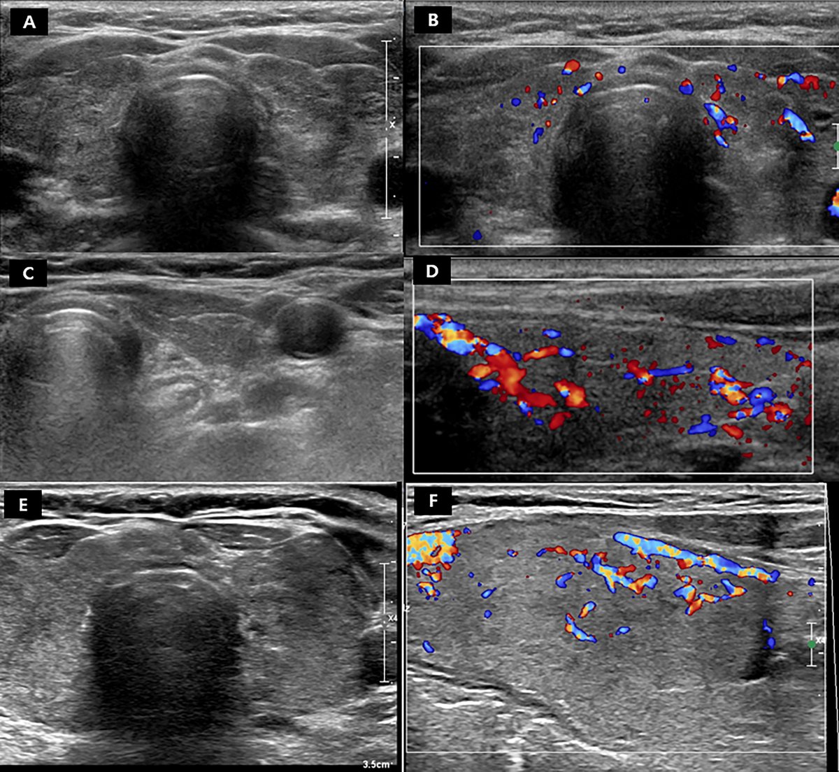 Radiology (@radiology_rsna) on Twitter photo In this prospective study, the presence of diffuse thyroid disease and intratumoral vascularity at US helped accurately predict tumor progression in participants with low-risk papillary thyroid microcarcinoma during active surveillance. <a href="/SNU_Rad/">SNU Radiology</a> bit.ly/3QE4fBX In this prospective study, the presence of diffuse thyroid disease and intratumoral vascularity at US helped accurately predict tumor progression in participants with low-risk papillary thyroid microcarcinoma during active surveillance. <a href="/SNU_Rad/">SNU Radiology</a> bit.ly/3QE4fBX