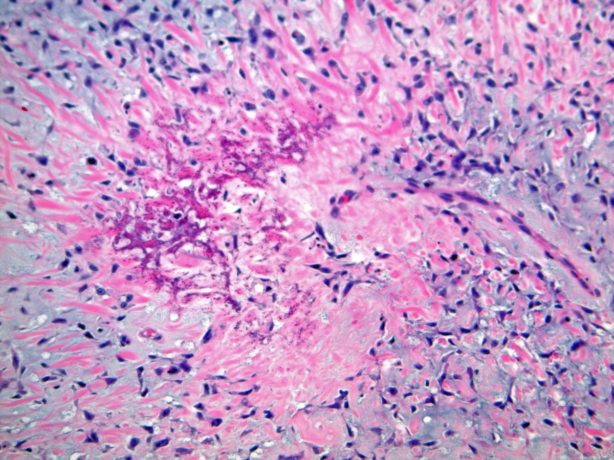 ScottBikeethan's tweet photo. Non-uniform cellularity, particularly if it is more prominent peripherally, coupled with significant atypia strongly favors chondroblastic osteosarcoma, even in the absence of definite osteoid/bone production on biopsy. Of course, on resection you'll find it at least focally. https://t.co/sBGReDFuin