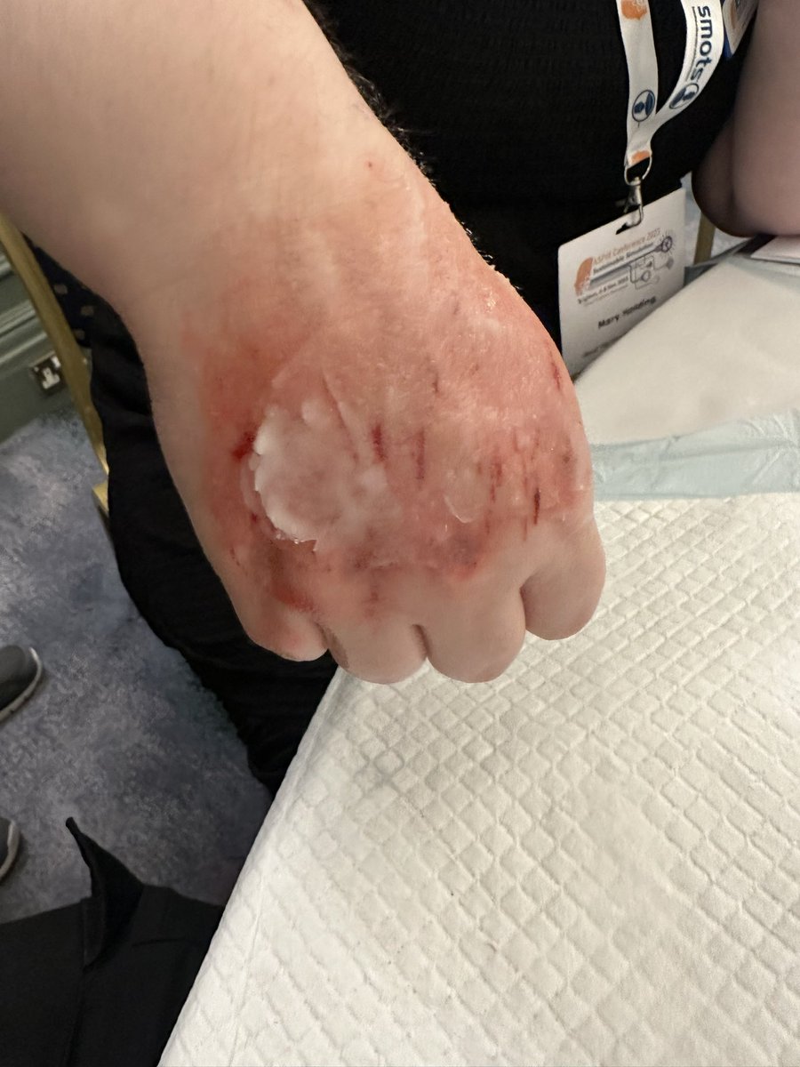 AlPurvisSJA's tweet photo. Great Moulage Cpd workshop bruises, grazes and chemical burns @ASPiHConf @ASPiHUK @SJASimbulance @SJAIntTraining https://t.co/WJwLJAIyBZ