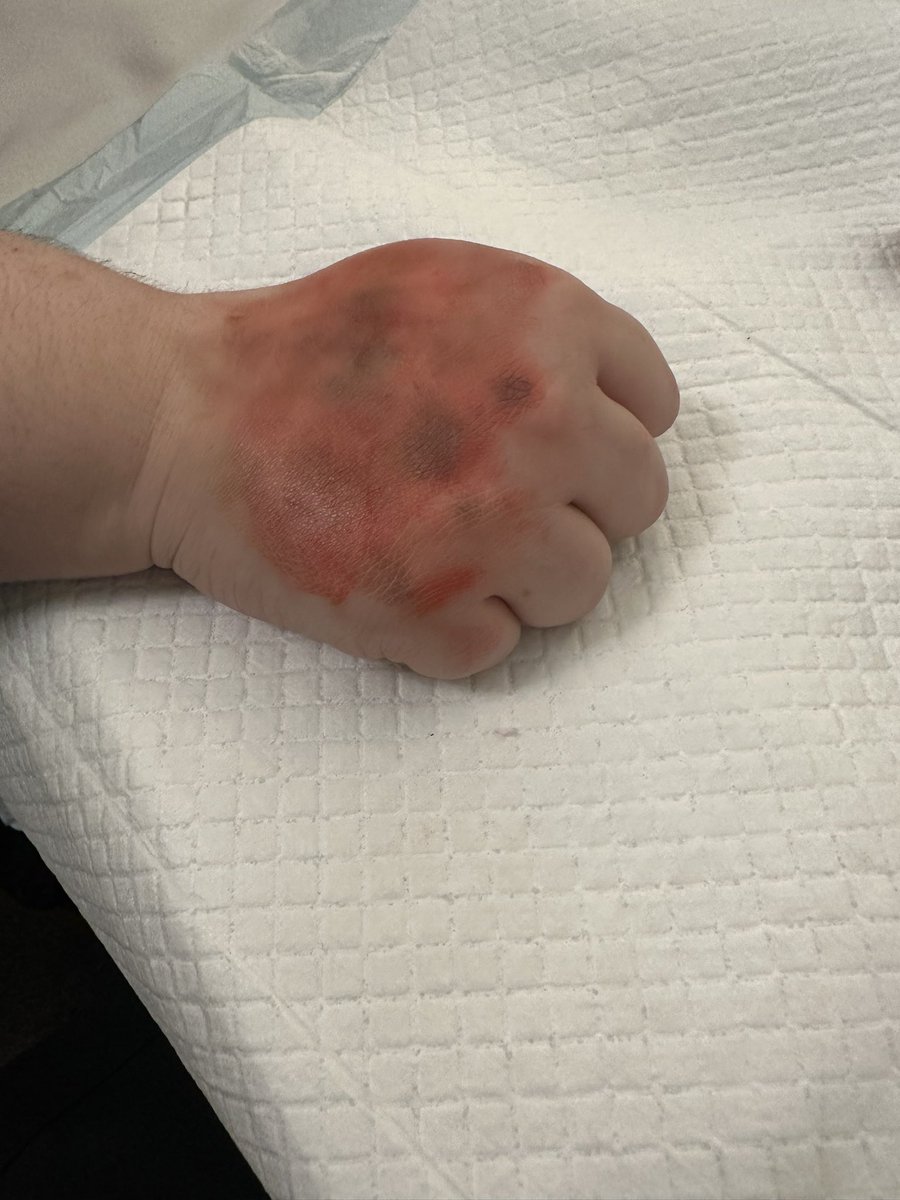 AlPurvisSJA's tweet photo. Great Moulage Cpd workshop bruises, grazes and chemical burns @ASPiHConf @ASPiHUK @SJASimbulance @SJAIntTraining https://t.co/WJwLJAIyBZ
