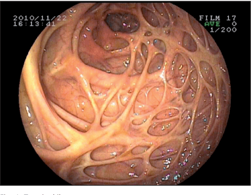 Appearance of the right colon in a patient with chronic diarrhoea. What's the diagnosis?