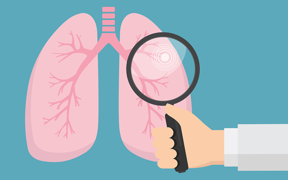 phanav2's tweet photo. Almost 5 million additional Americans are now being recommended to get a #lungcancer screening according to a new guideline from the @AmericanCancer Society. Check out this article from @CNN for more information! https://t.co/L2N60uyg2j #MASC336 https://t.co/nmL9uftTkk