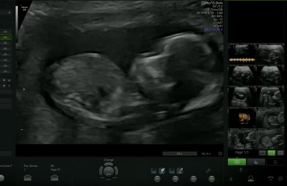 Happy half way to me and baby boy 🩵 #20weeks