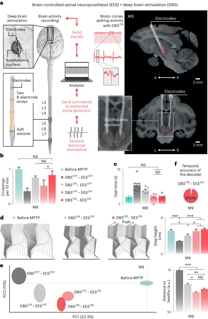 ¡Gran avance científico!
Una persona con enfermedad de Parkinson desde hace 25 años vuelve a caminar gracias a una prótesis neuronal que estimula la médula espinal directamente, logrando evitar las caídas y bloqueos en la marcha. nature.com/articles/s4159…
elpais.com/ciencia/2023-1…