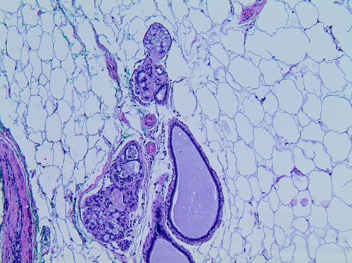 mhassanaimc's tweet photo. Am I missing cribriform DCIS? #breatpath ๐๐๐๐๐๐๐๐๐ https://t.co/GfKzgoerqv
