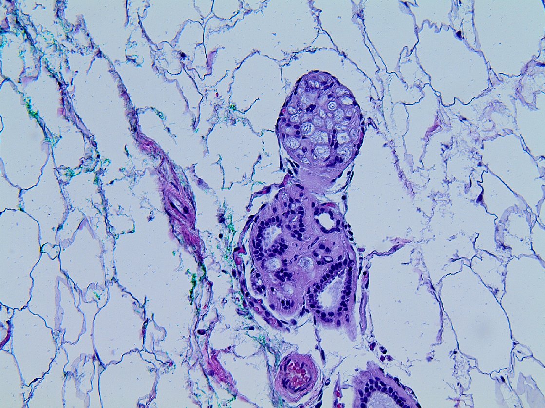 mhassanaimc's tweet photo. Am I missing cribriform DCIS? #breatpath ๐๐๐๐๐๐๐๐๐ https://t.co/GfKzgoerqv