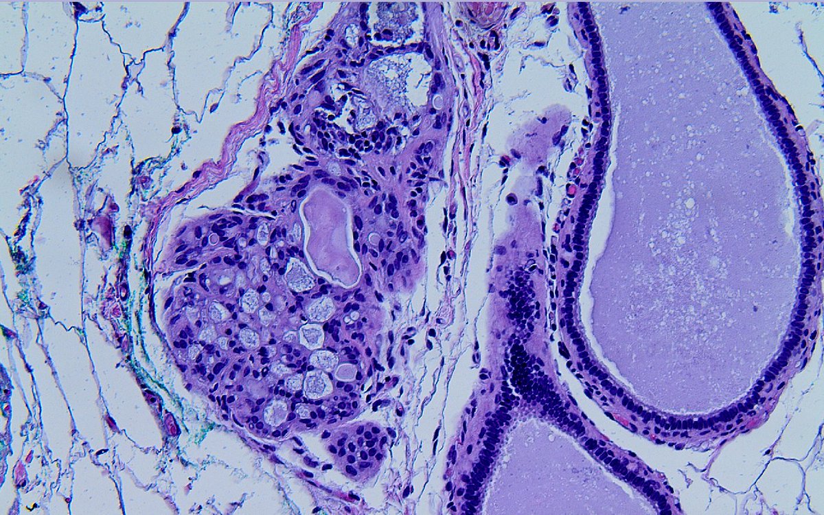 mhassanaimc's tweet photo. Am I missing cribriform DCIS? #breatpath ๐๐๐๐๐๐๐๐๐ https://t.co/GfKzgoerqv