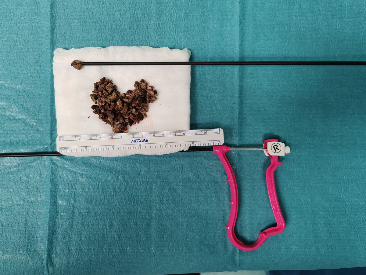 GuidoGiusti's tweet photo. No matter if u have #trilogy  by @EMSUrology or #shockpulse by @OlympusUrology like I have.... when the stone is really big, I find very useful to speed up litholapaxis #singleuse  grasper such as #percX by @rocamed …. In this case at least 30 min saved #ETCE https://t.co/EZcUsBDJeV