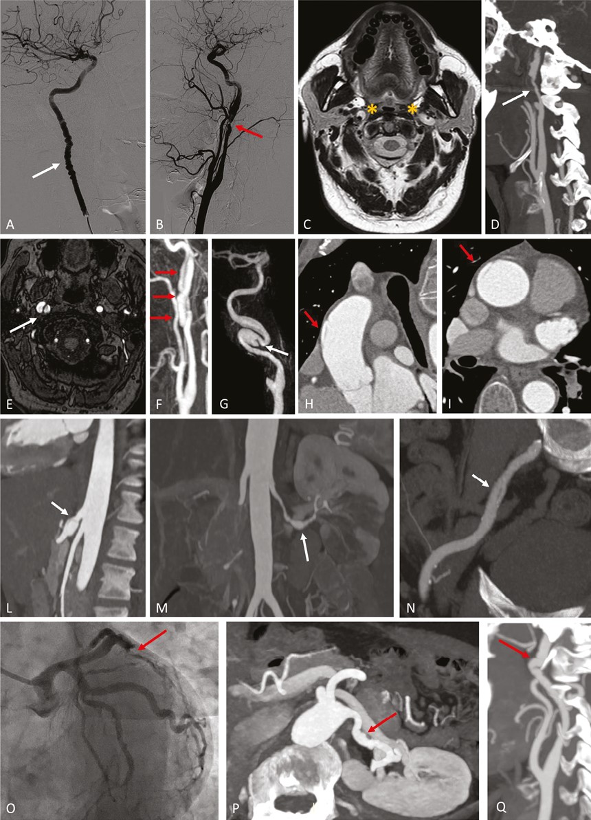 From Fibromuscular Dysplasia to Arterial Dissection and Back - a state of the art review from Huart, Persu et al @ULiegeRecherche 🔗academic.oup.com/ajh/article/36… 🔓#OpenAccess #EditorsChoice from @ESchiffrin so always #Free