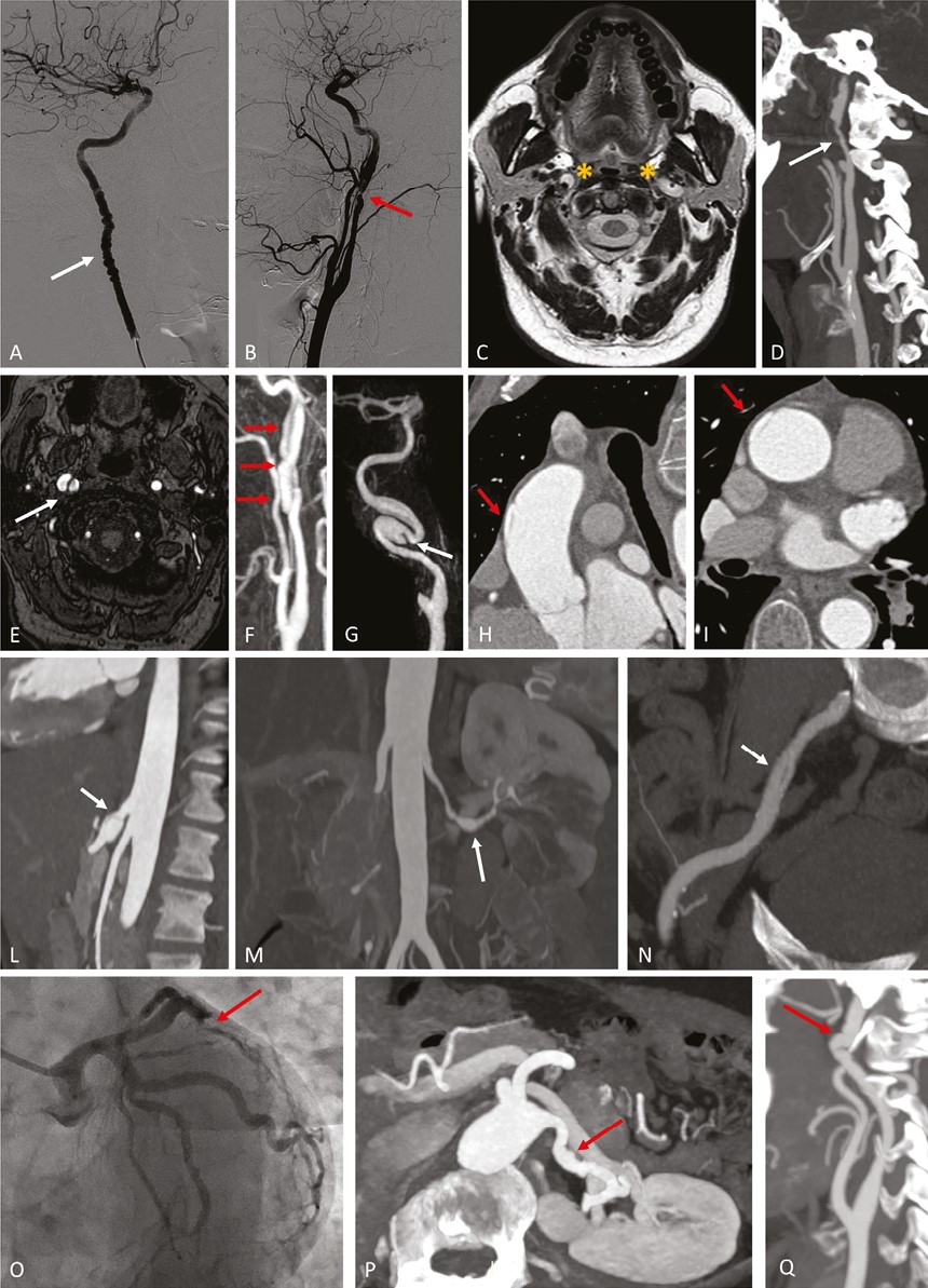 From Fibromuscular Dysplasia to Arterial Dissection and Back - a state of the art review from Huart, Persu et al <a href="/ULiegeRecherche/">ULiège Research & Innovation</a> 

🔗academic.oup.com/ajh/article/36…

🔓#OpenAccess #EditorsChoice from <a href="/ESchiffrin/">Ernesto Schiffrin</a> so always #Free