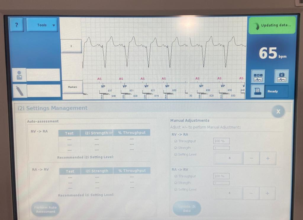 CyrusHadadiMD's tweet photo. Two of the 1st AVEIR DR implants in the world(!) today at @MedStarHealth @MedStarWHC! Amazing outcomes for our patients with CHB - AV synchrony with completely leadless @AbbottCardio AVEIR DR dual chamber pacemakers! #GameChanger #AVEIR https://t.co/3JbOa5evsA