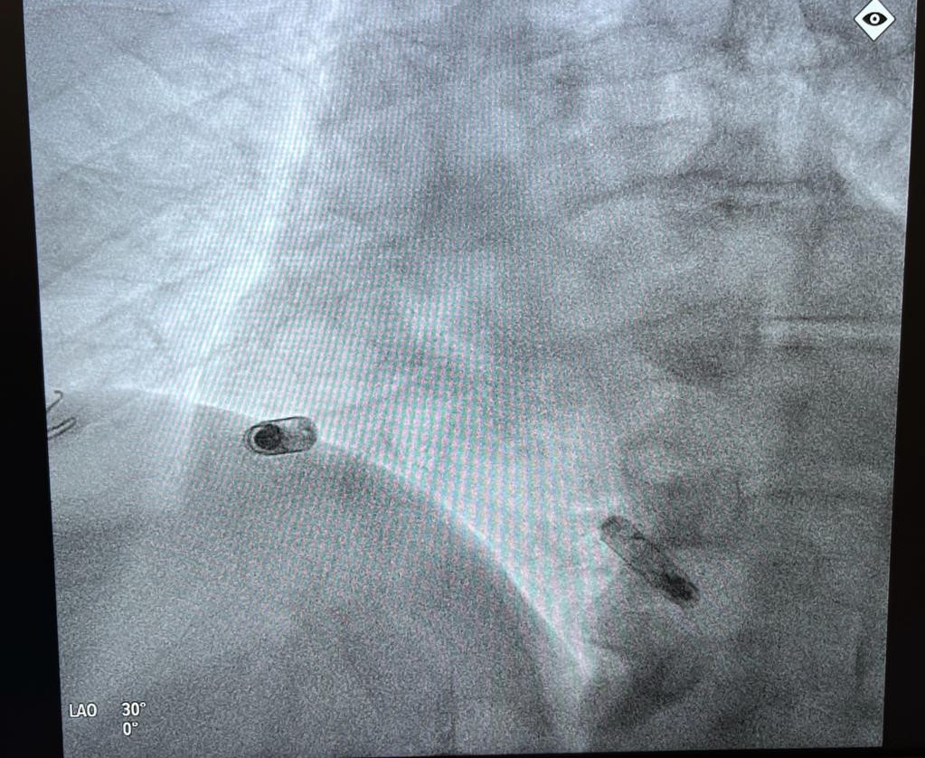 CyrusHadadiMD's tweet photo. Two of the 1st AVEIR DR implants in the world(!) today at @MedStarHealth @MedStarWHC! Amazing outcomes for our patients with CHB - AV synchrony with completely leadless @AbbottCardio AVEIR DR dual chamber pacemakers! #GameChanger #AVEIR https://t.co/3JbOa5evsA