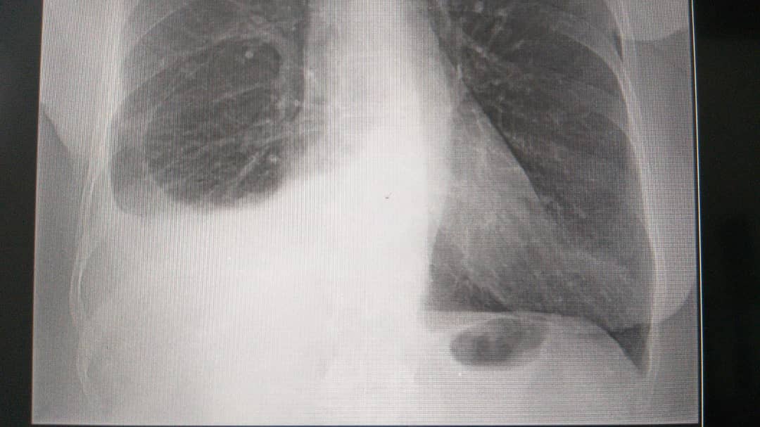 Esto fue del pulmón que se me olvidó subir la foto de los rx. Mi mamá ya no quería someterse a nada, pero la recomendación de los doctores es que inicie nuevamente el tratamiento.