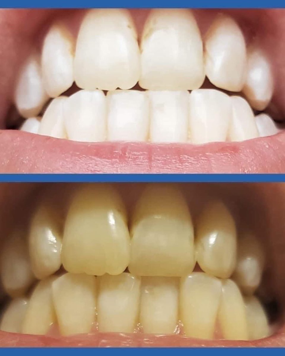 KayT3304's tweet photo. Plus, it's sugar-free, gentle on enamel, and safe for kids! If you're a coffee or wine lover like me, it's a stain-fighting superhero. Even dentists recommend it!

If you're interested in trying it out or learning more, feel free to reach out to me or click the link. https://t.co/Ut5e5TXuym