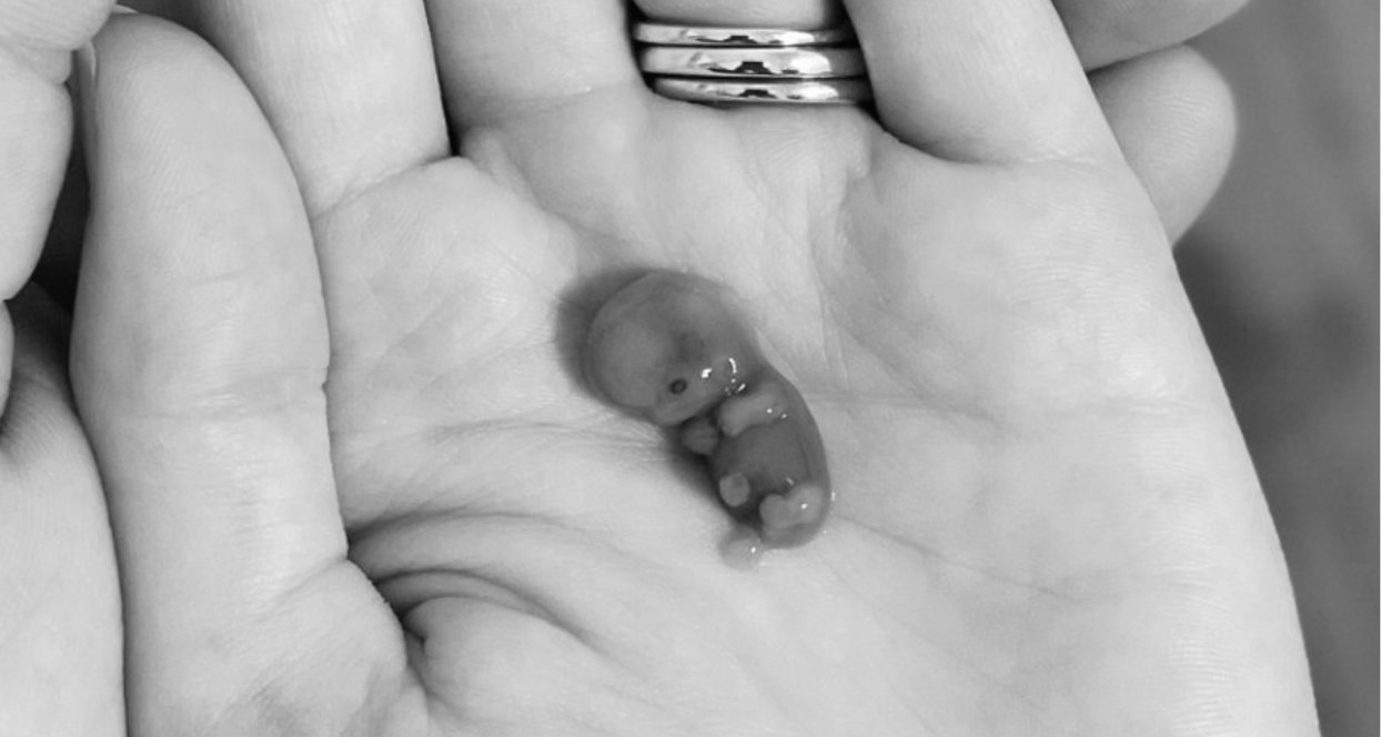 Week Old Fetus Miscarriage week-old-fetus-miscarriage