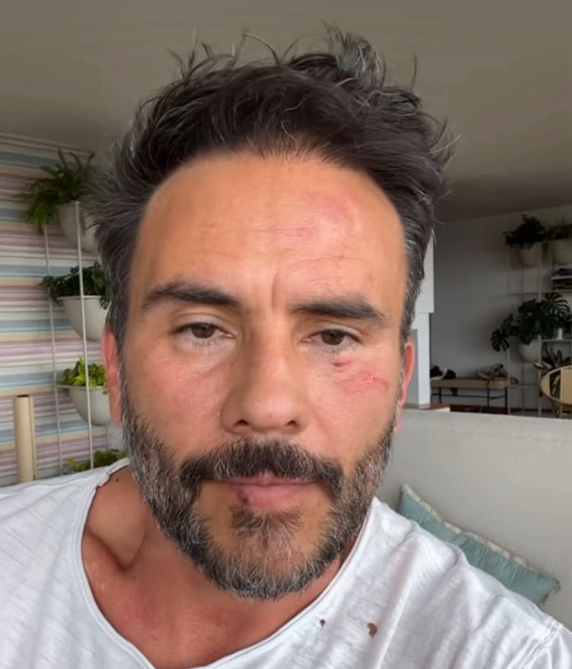 JotaPeHernandez's tweet photo. El empresario Carlos Rios desaparecido y el actor Juan Pablo golpeado y atracado. No solo ellos fueron atracados hoy en los cerros orientales de Bogotá, hay más víctimas. LOS BANDIDOS ESTÁN DESATADOS aprovechando la impunidad y los beneficios que ofrecen quienes nos gobiernan. https://t.co/pyHQzY34l1