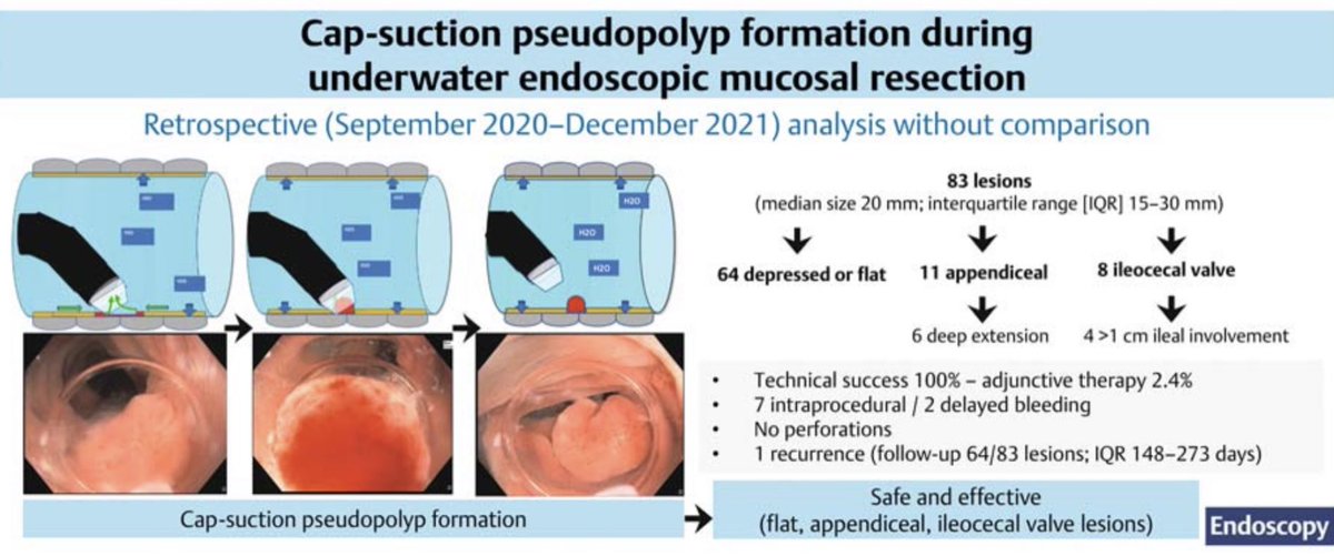 iborraignacio's tweet photo. In this month’s @endoscopyjrnl look for our work on CAP-UEMR for challenging lesions 🧐

https://t.co/g9zD3XbD9T https://t.co/OEoZG3iUqh