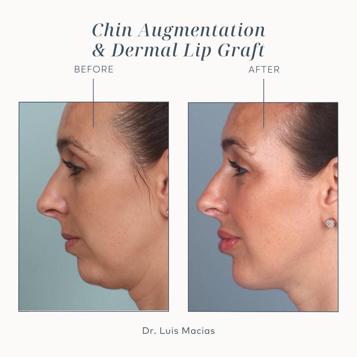 A balancing act ⚖️
This patient wanted to permanently augment her lips and chin. I suggested a chin implant and dermal graft from her tummy tuck skin. These changes provided the greatest facial harmony between her nose, lips, and chin. #chinaugmentation #facialbalancing #lipgraft