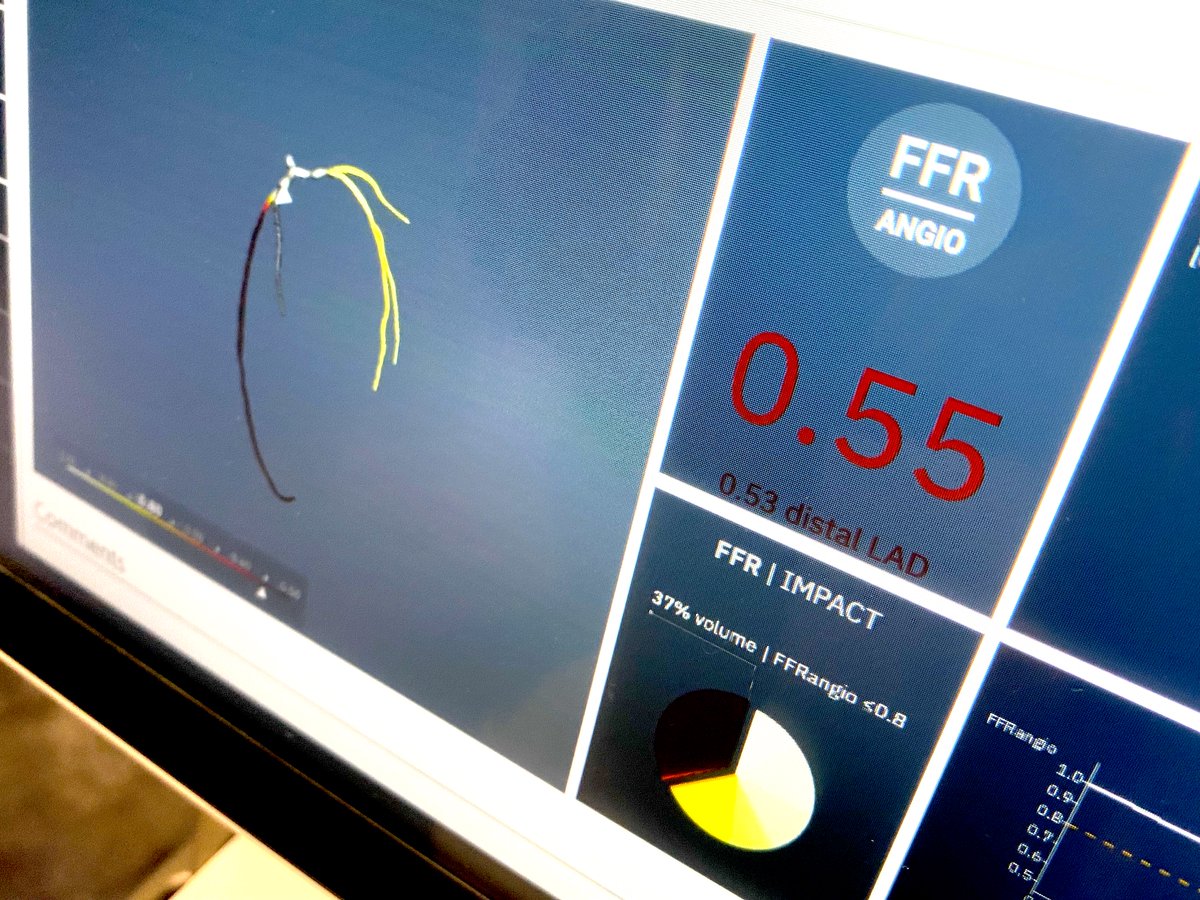 Examples of fractional flow reserve derived from rotational angiography (FFR-angio) in the cath lab to avoid the need for pressure wires. Tech shown by CathWorks in the Medtronic booth at #TCT2023 - cardiovascularbusiness.com/topics/profess… #Cardiotwitter #FFR #FFRangio